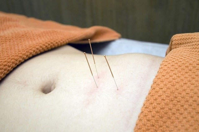 acupuncture g6c547795c 640