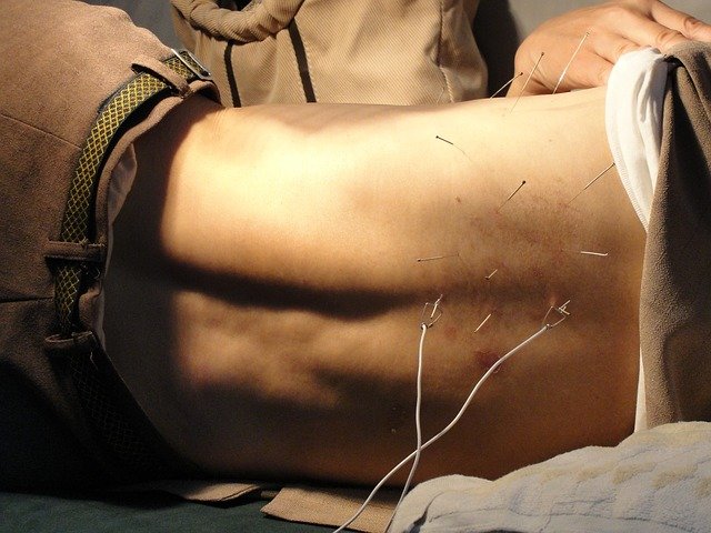 acupuncture gbf399706d 640